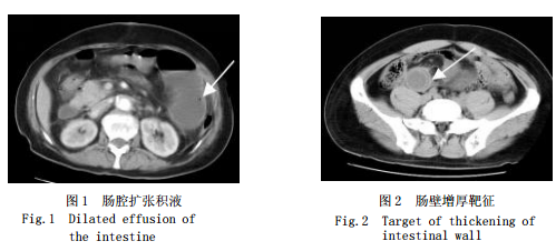 絞窄性腸梗阻 MDCT 表現(xiàn)