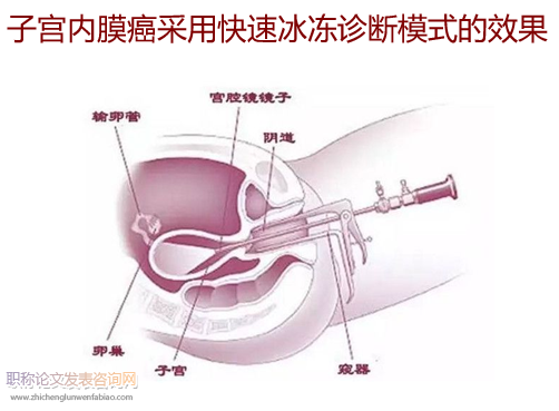 子宮內(nèi)膜癌采用快速冰凍診斷模式的效果